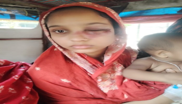 কুড়িগ্রামের উলিপুরে কিশোর গ্যাং এর তান্ডবে চোখের দৃষ্টি হারাতে বসেছে এক গৃহবধু