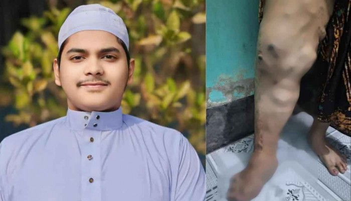 বিরল রোগে আক্রান্ত মাদরাসা ছাত্র নাজমুল, চিকিৎসায় দরকার ১২ লাখ টাকা।
