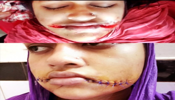 বানারীপাড়ায় বখাটের কাস্তের আঘাতে কলেজ শিক্ষার্থীর মুখমন্ডল ক্ষত বিক্ষত